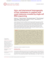 Intra- and intertumoral heterogeneity of liver metastases in a patient with uveal melanoma revealed by single-cell RNA sequencing